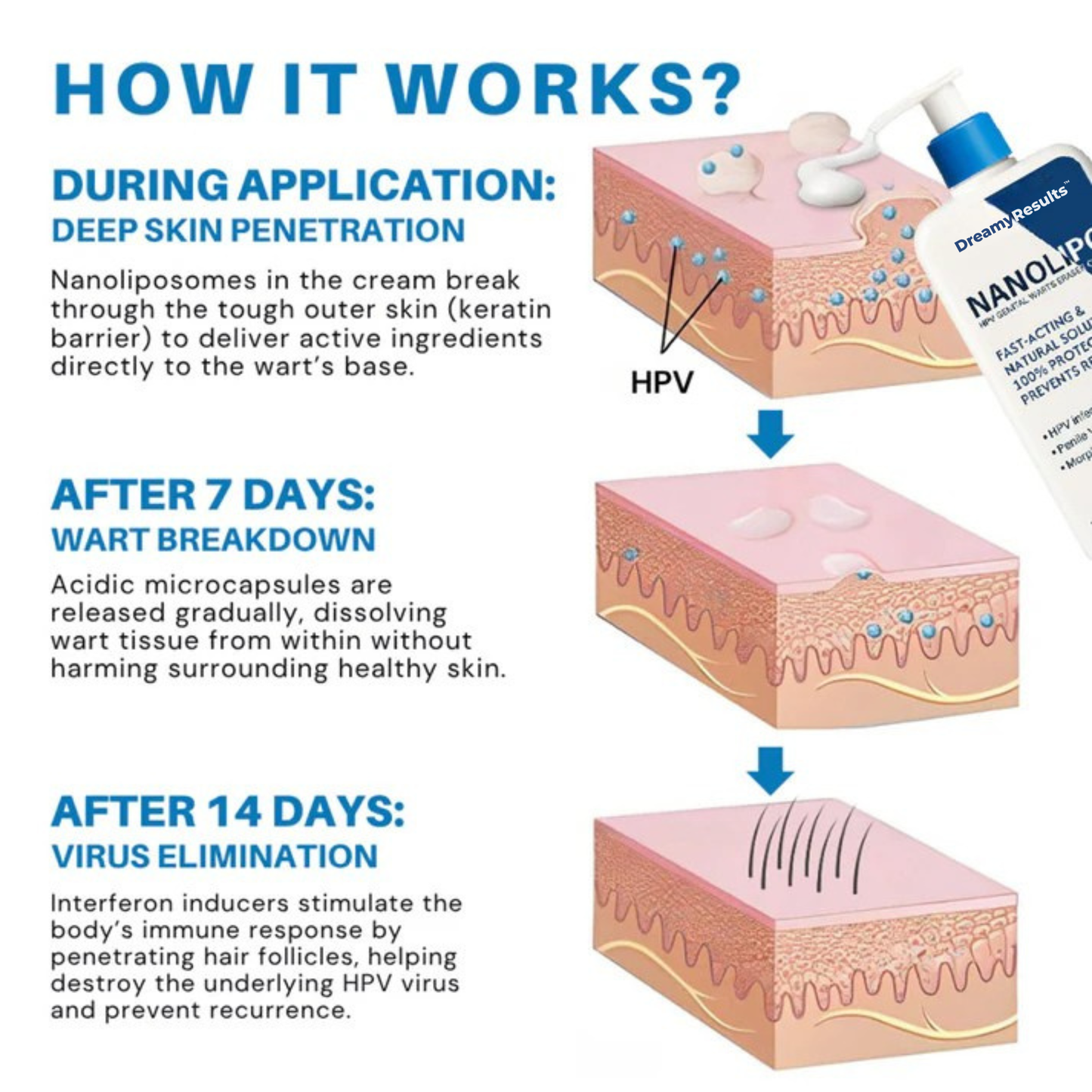 DreamyResults® NanoLipo HPV Warts Eraser Cream
