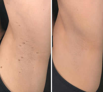 DreamyResults® 2-in-1 Microneedle & Hydrocolloid Patch