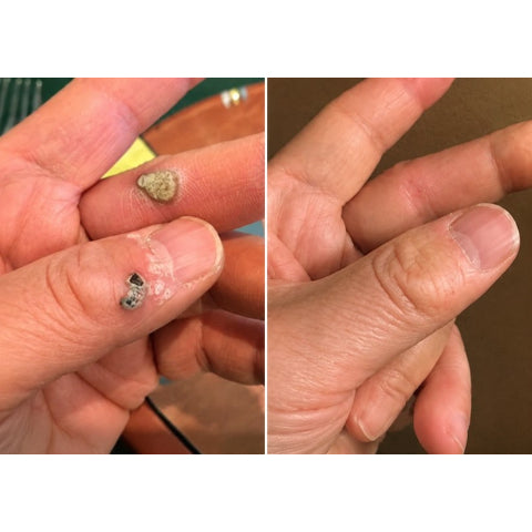 DreamyResults® 2-in-1 Microneedle & Hydrocolloid Patch